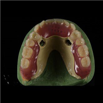 Зъбна протеза Peek Framework